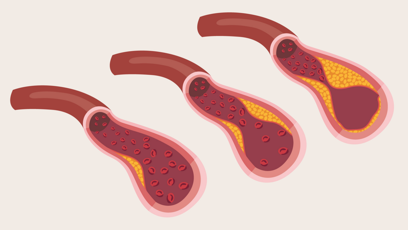 An illustration showing the narrowing of the heart’s arteries.