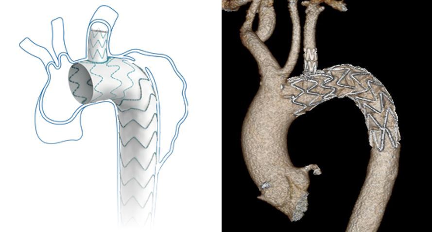 Lombard Castor stent for unibody TEVAR procedure