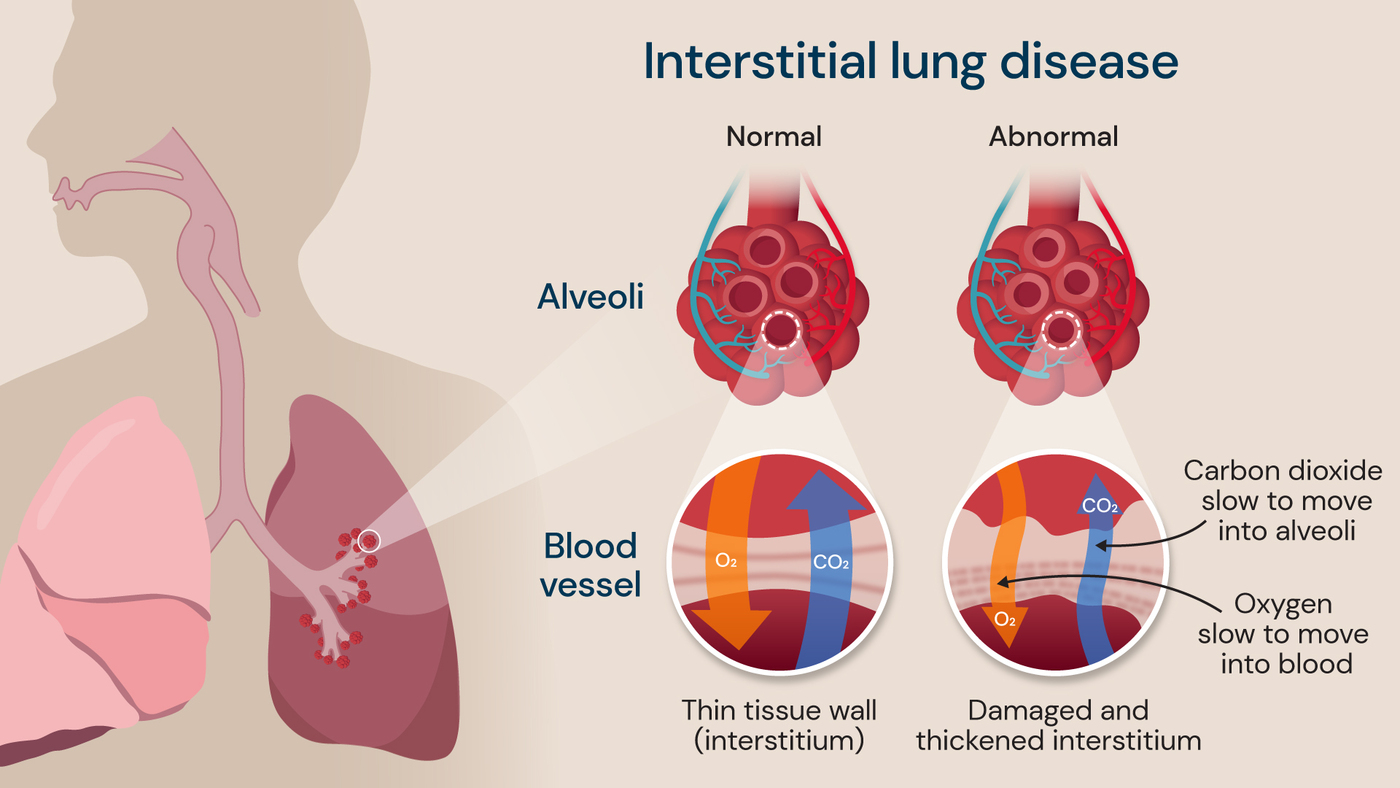 An illustration showing interstitial lung disease