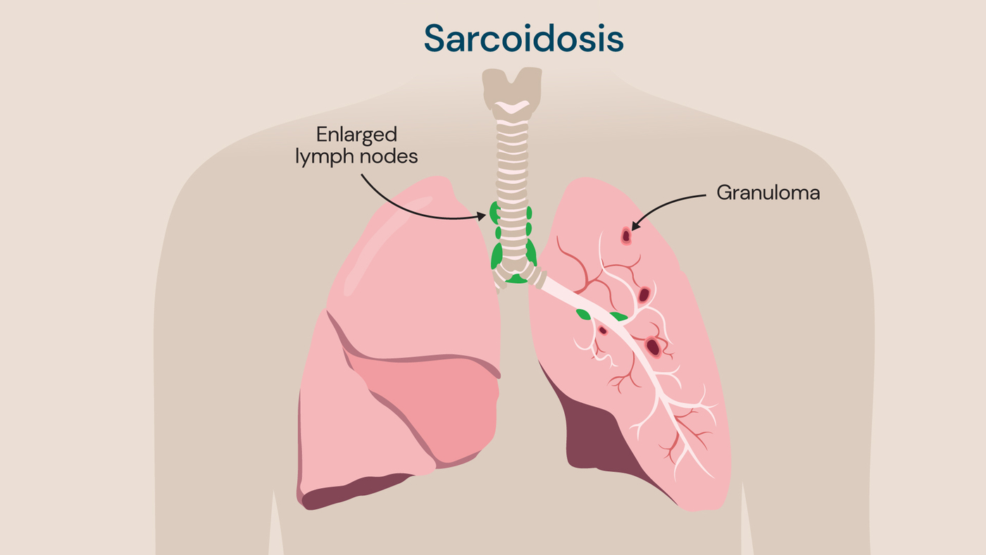 Pulmonary sarcoidosis