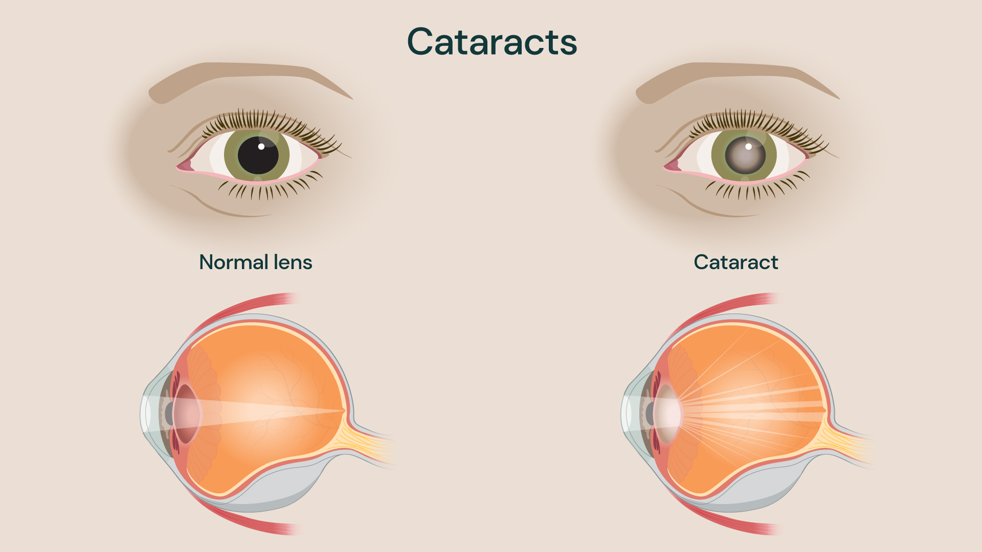 Illustration of an eye with and without cataracts