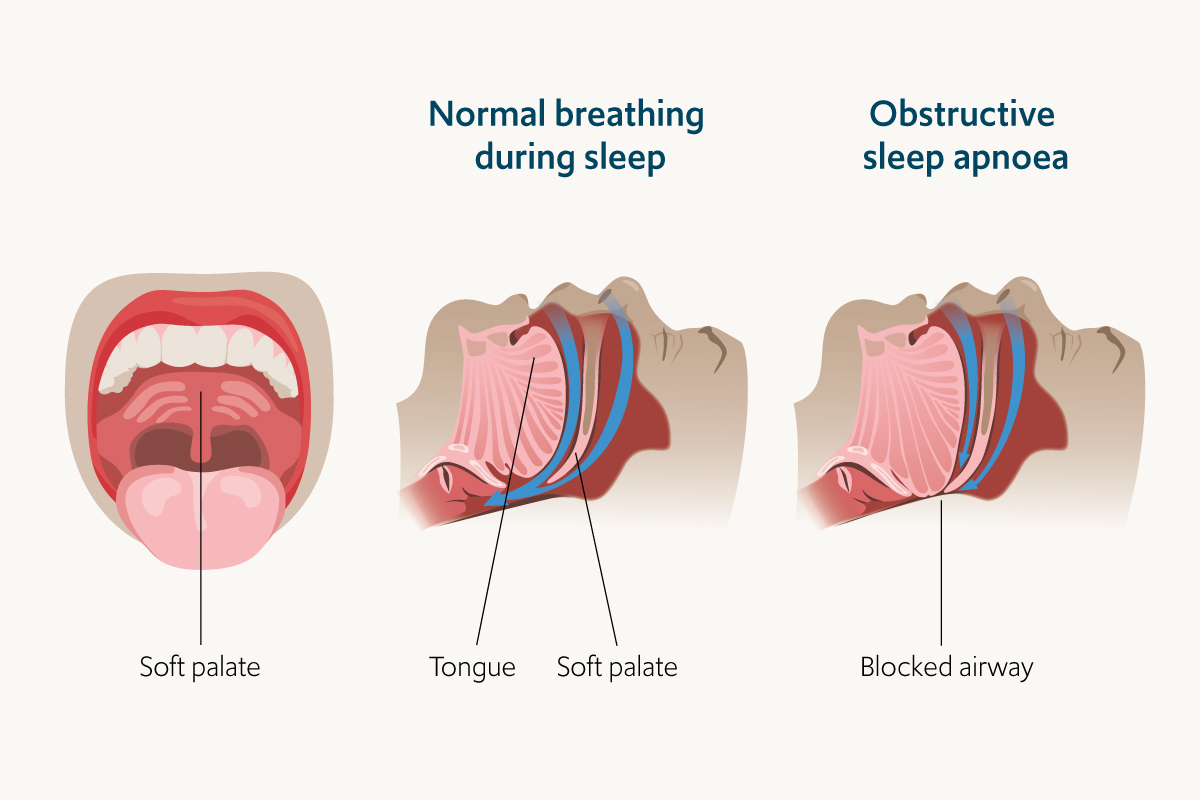 An illustration showing obstructive sleep apnoea during sleep