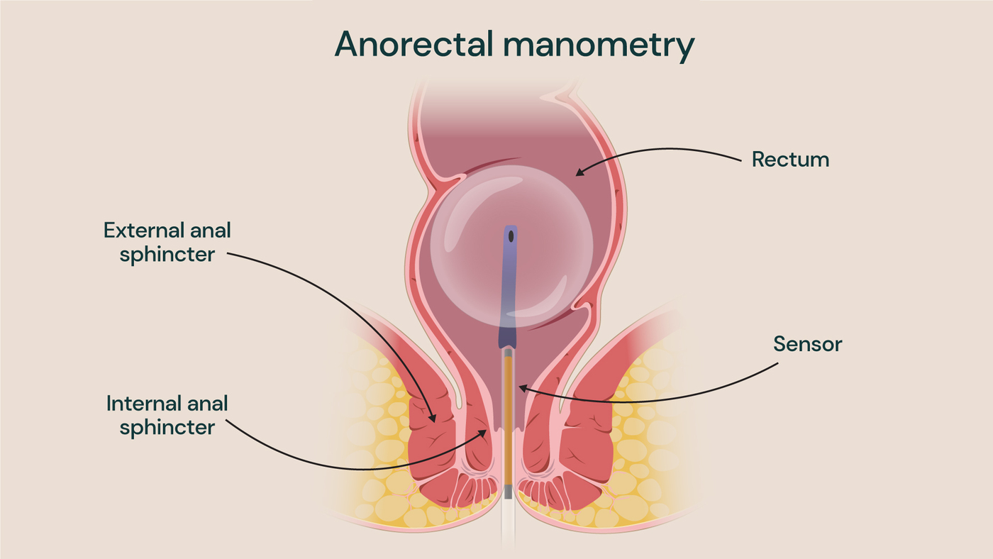 An illustration showing Anorectal manometry