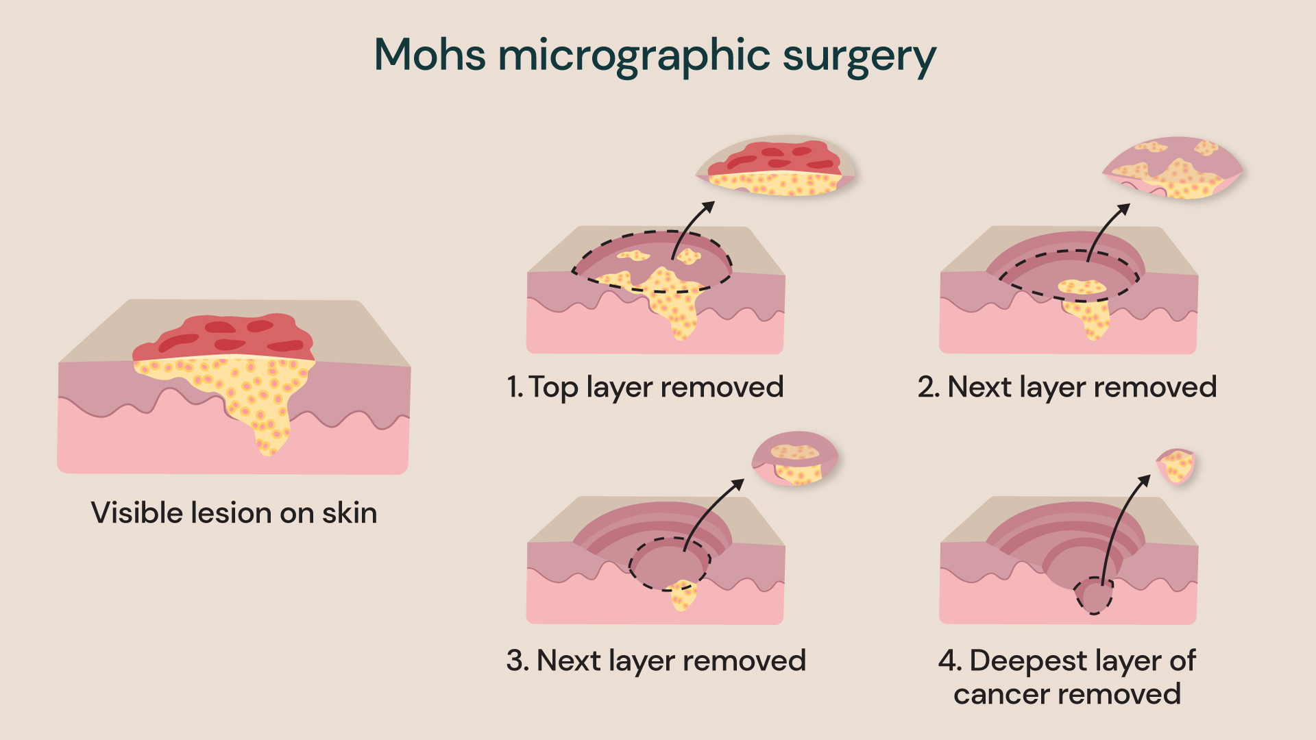 Mohs micrographic surgery