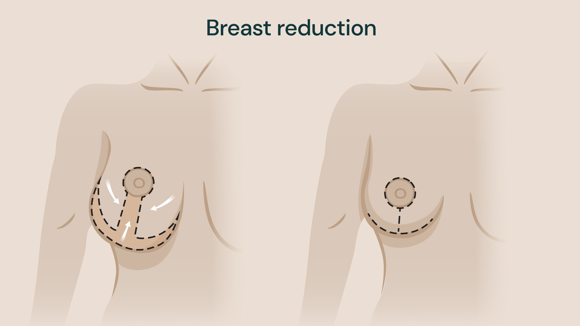 Breast reduction surgery