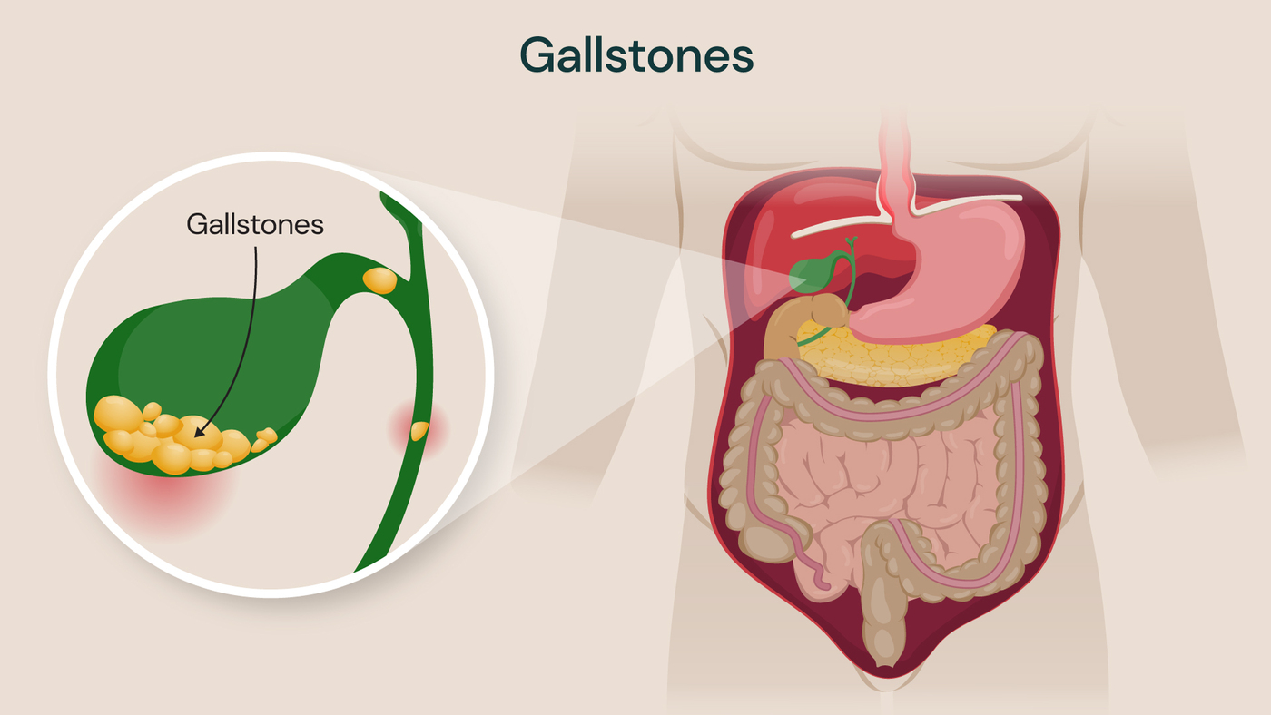 Medical illustration of gallstones showing small solid stones within the gallbladder alongside a full view of the digestive system, including the liver, stomach and intestines.