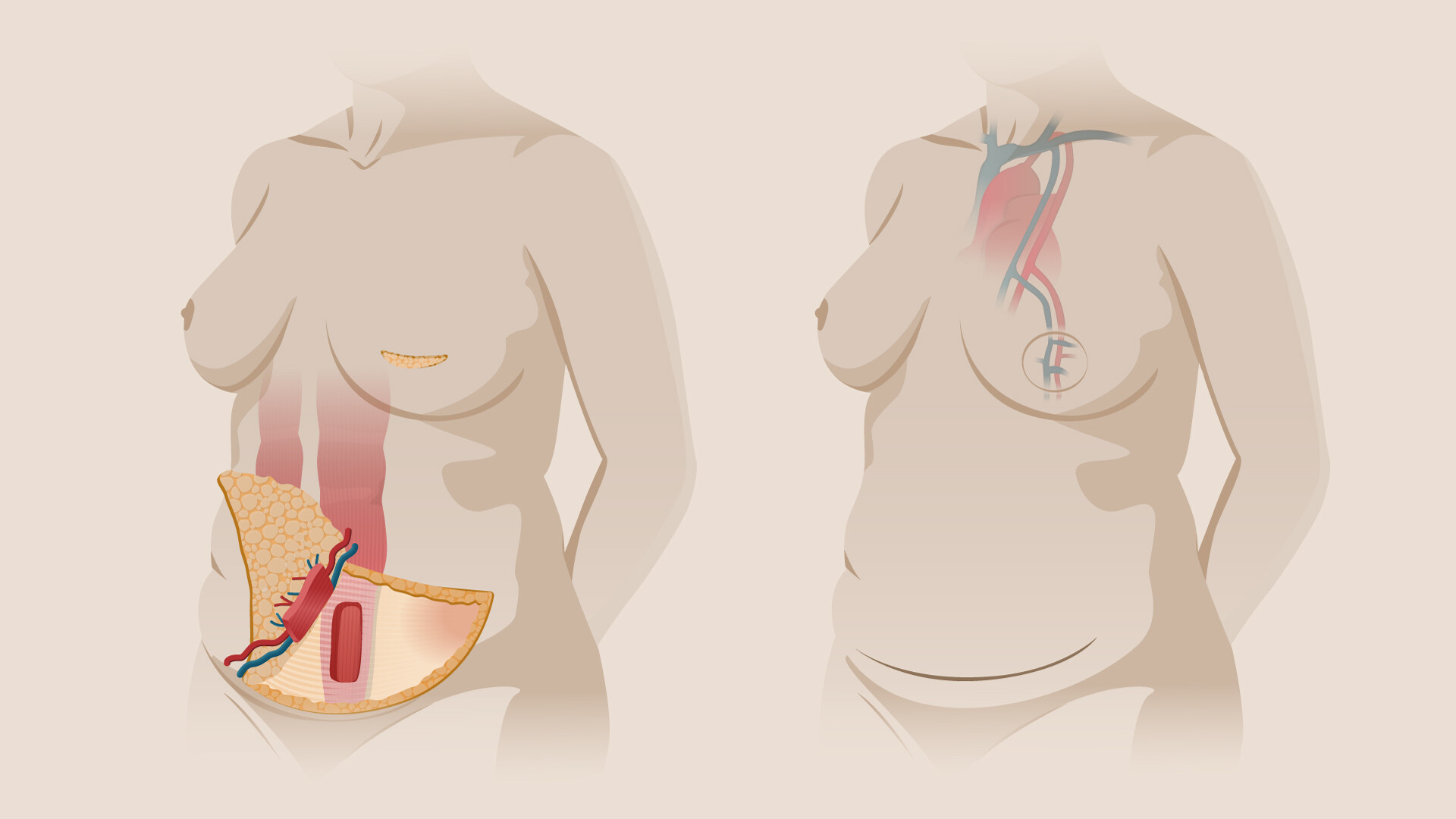 An example flap reconstruction